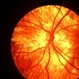 Choroidal atrophy Choroidal atrophy